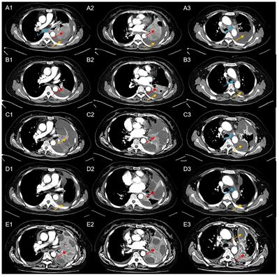 A novel secondary ALK gene mutation which resistant to second-generation TKIs: a case report and literature review
